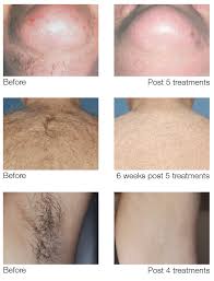 laser hair removal treatment at faces