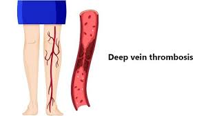 Thrombosis frequently occurs in the arms and legs, including thighs, calves and ankles. Deep Vein Thrombosis Dvt Causes Symptoms And Treatment