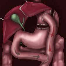 gastric byp ohio state bariatric