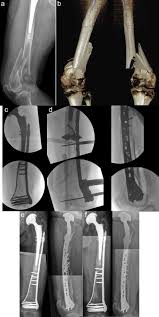 distal fem fractures