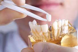 مخاطر زراعة الأسنان- 6 مشكلات قد تصيبك بها | الكونسلتو