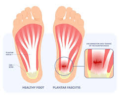 stretches for plantar fasciitis you