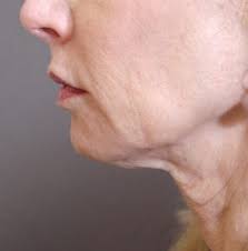 how to tighten sagging jowls doctor