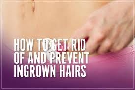 You can get ingrown hairs anywhere you grow hair, whether it's ingrown leg hair, ingrown pubic hair, ingrown armpit hair, or ingrown facial hair. How To Get Rid Of Prevent Ingrown Hairs Treatment Guide