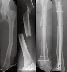 segmental fem shaft fracture after