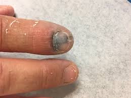 would you remove this fingernail