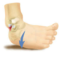 ankle sprain home remedy ssorkcssorkc