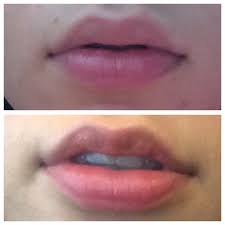 8 days post juvederm my lips are plump
