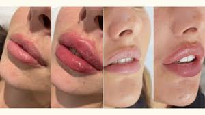 russian lip filler technique vs normal