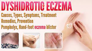 dyshidrotic eczema causes types