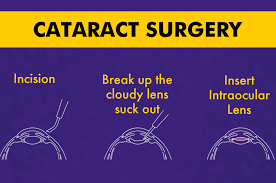 types of cataract surgery which is