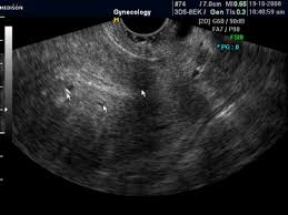 uterine artery doppler