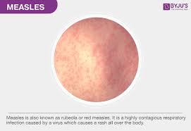 Outbreaks of rsv infection occur every winter, and individuals can be reinfected, as previous infection does not appear to cause lasting immunity. Measles Causes Symptoms Treatment Prevention