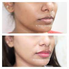 lip pigmentation treatment in mumbai