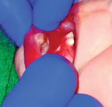 ulcers of the tongue springerlink