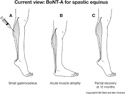 gastrocnemius muscle