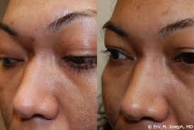 acne scar correction