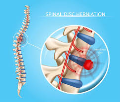 herniated disc how a spine specialist