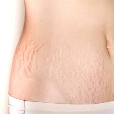 stretch marks removal singapore laser