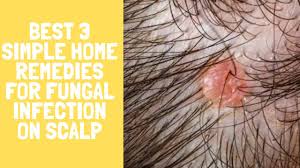 scalp natural home remedy