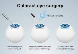 after cataract surgery
