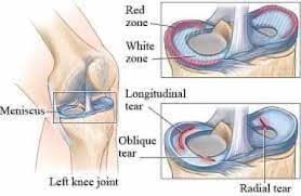 meniscus tear causes symptoms treatment