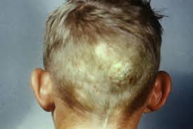 Hair loss refers to a loss of hair from the scalp or body. Tinea Capitis