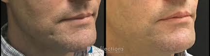 acne scars injections new jersey