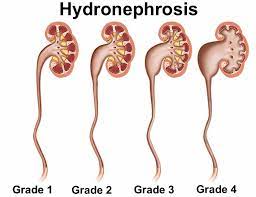 hydronephrosis causes symptoms