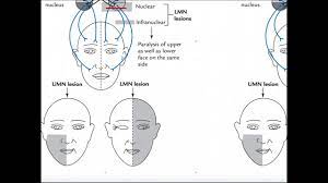 mechanism of bell s palsy and