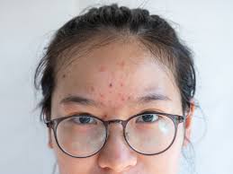 6 types of acne causes symptoms