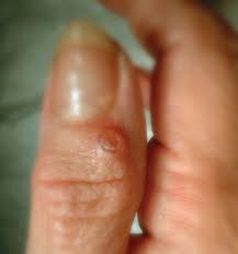 treatment of finger cysts at raleigh