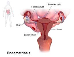 The tissue is commonly found on the ovaries, supporting ligaments of the uterus, and in the cavities of the pelvis. Endometriosis Wikipedia