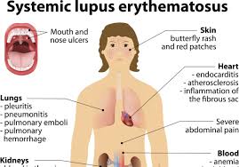 joint pain lupus is an elusive disease