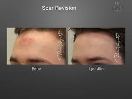 scar revision keloid treatment new