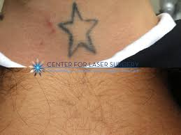 Tattoo Removal Washington Dc Center For Laser Surgery