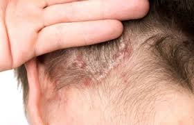understanding your itchy scalp
