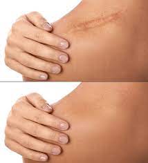 scar removal what to know organic