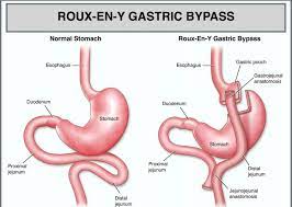 Anastomotic Leak and Death From Sepsis Following Gastric Bypass — Your  Trial Support