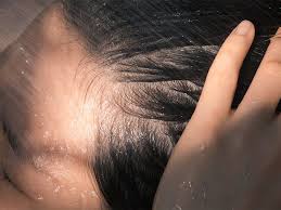 can lice cause hair loss understanding