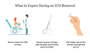 paragard iud removal what to expect