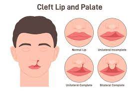cleft palate and cleft lip doctor