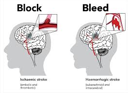 A stroke, also referred to as a cerebral vascular accident (cva) or a brain attack, is an fewer strokes are categorized as hemorrhagic, which occur when weakened blood vessels inside the brain. Types Of Stroke Enableme Stroke Recovery And Support