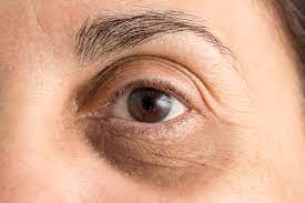 how to get rid of under eye wrinkles