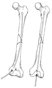 fem shaft fractures trauma