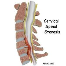 cervical spinal stenosis