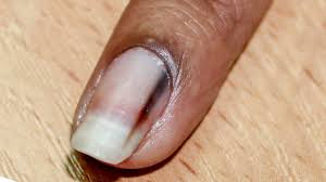 what s causing that black line on your nail