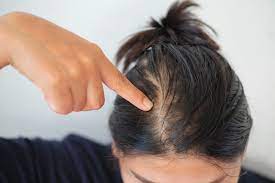 hair loss thinning menopause experts