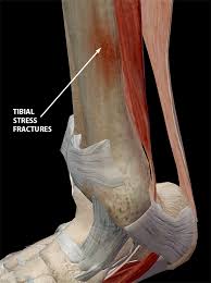 the anatomy and causes of shin splints