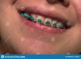 Teeth Of Young Woman With Orthodontic Treatment Stock Image